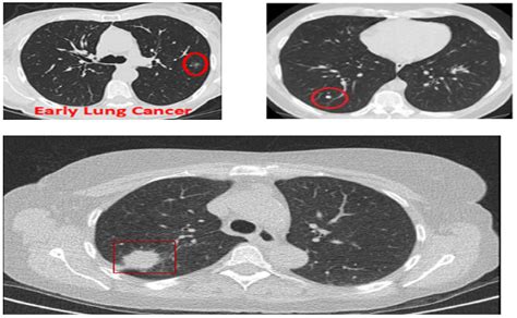 the villages lung ct scan|What to Expect from a Lung Cancer Screening .